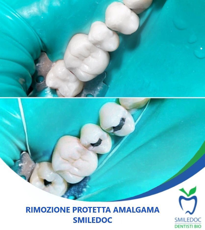 Rimozione Protetta Amalgama Dentale