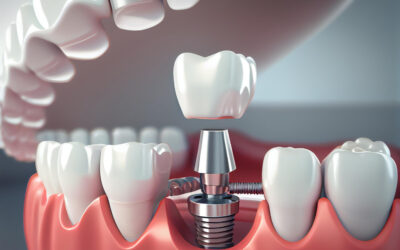 Impianti dentali in ceramica