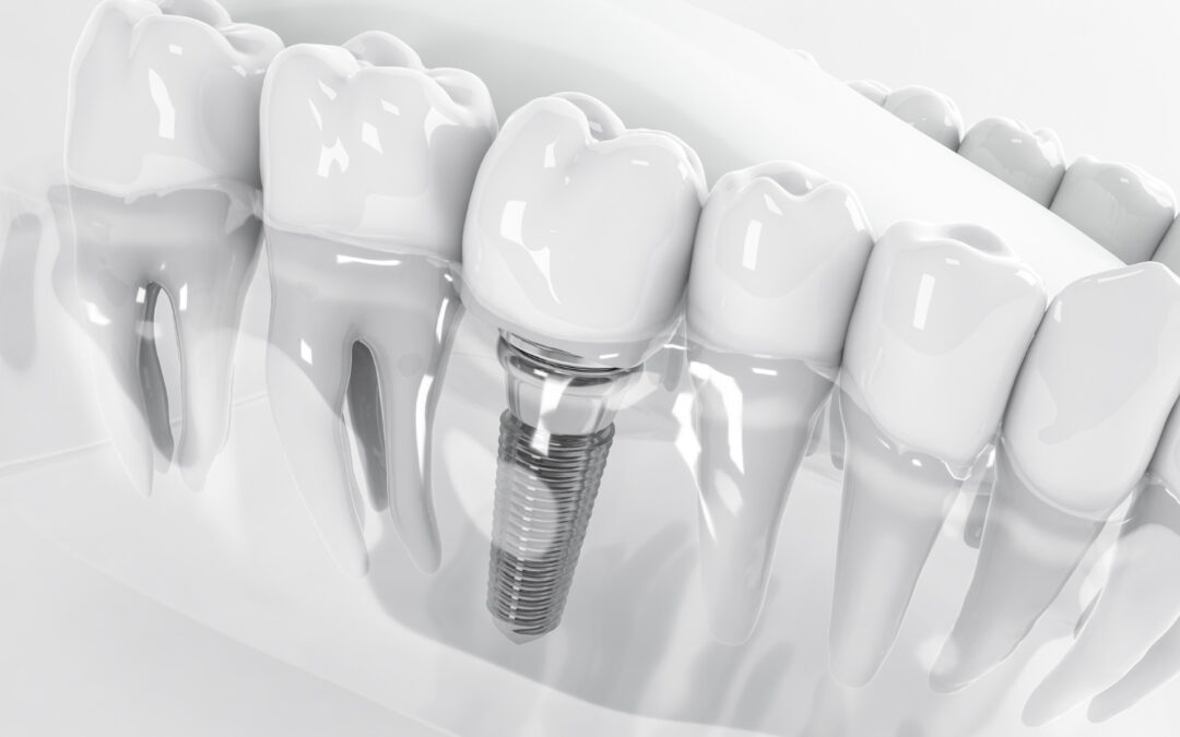 Impianti dentali in ceramica: le differenze