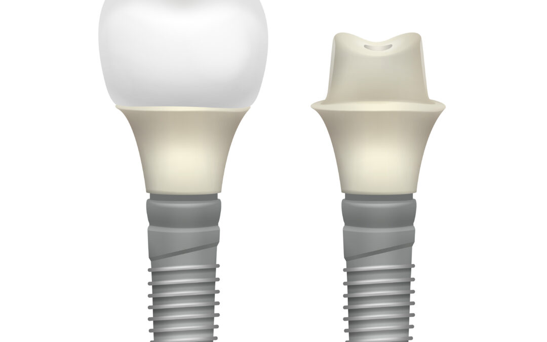 Impianto Bianco ceramico in Zirconia, il futuro dell’implantologia odontoiatrica?