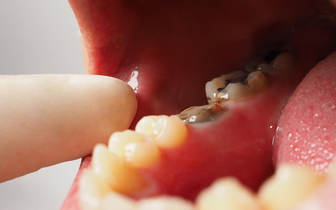 L’amalgama dentale fa male?