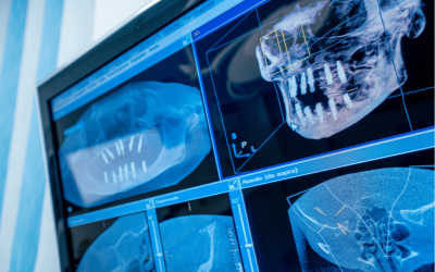 Implantologia dentale a Monterotondo: Soluzione definitiva per i denti mancanti