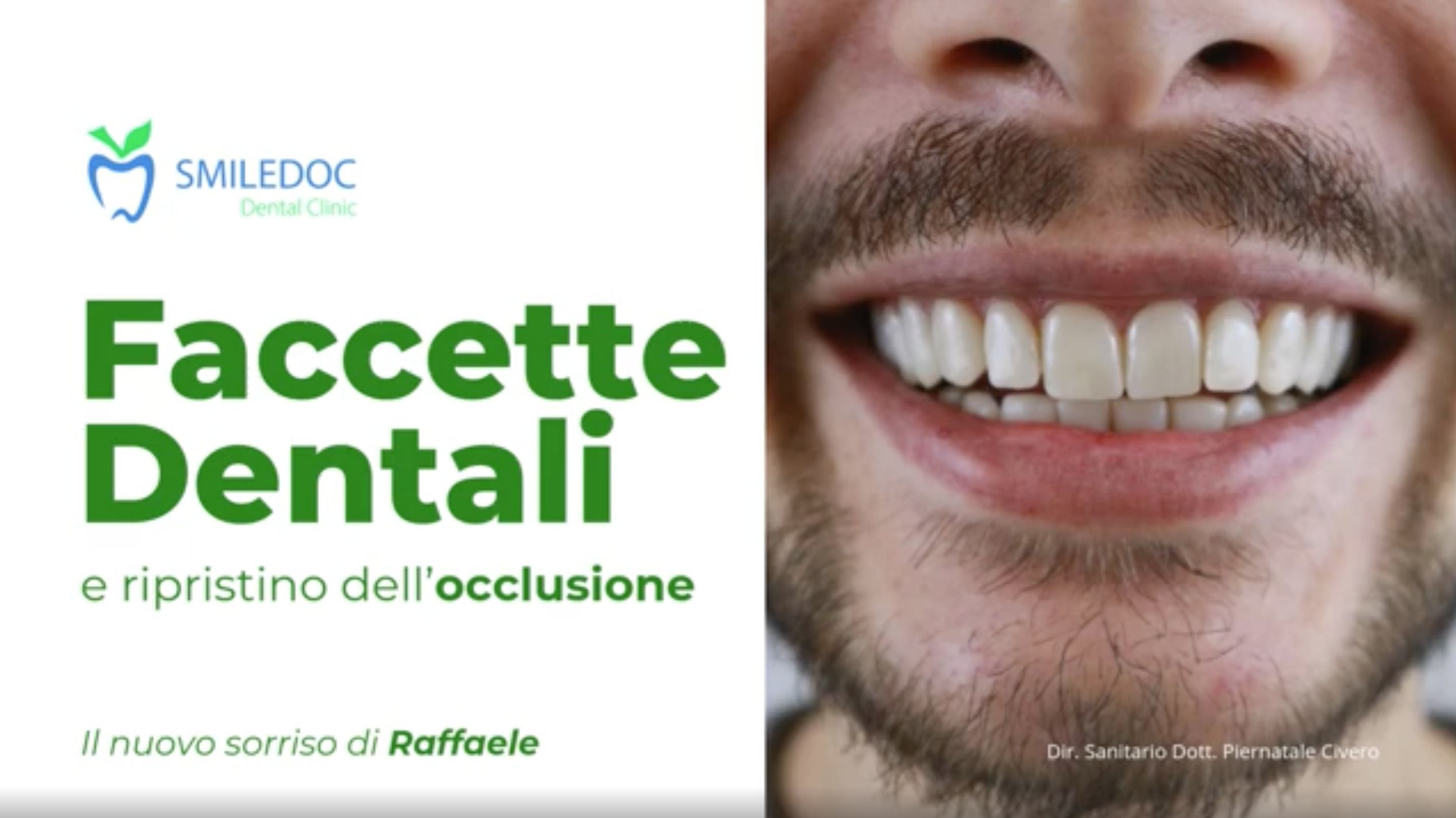 Faccette dentali e riabilitazione dell’occlusione