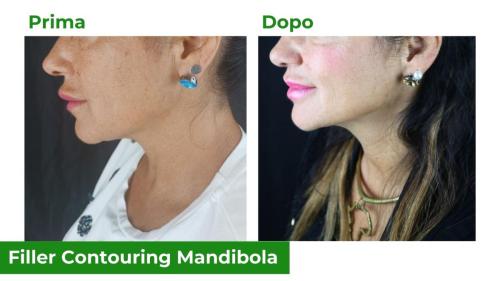 Filler contouring mandibola