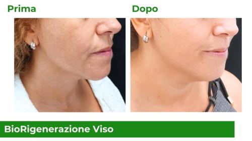 Biorigenerazione viso