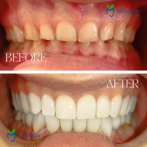 Faccette prima e dopo