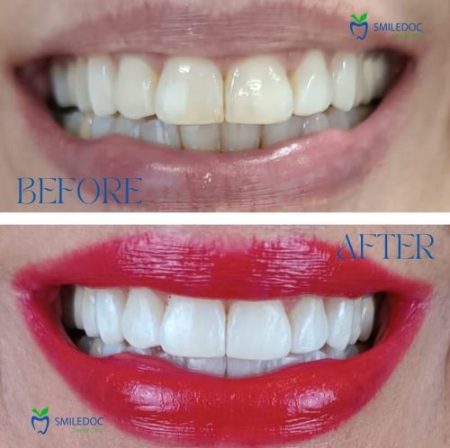 Sbiancamento prima e dopo